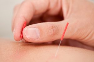 Dry-Needling FysioHeuveleind